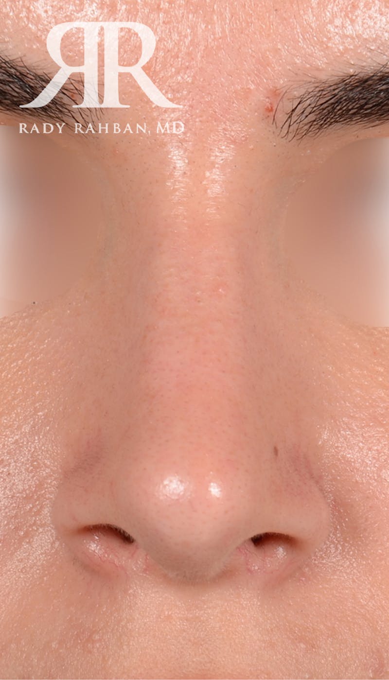 Rhinoplasty Close Up Before & After Gallery - Patient 262638 - Image 4