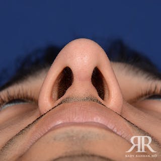 Male Rhinoplasty Before & After Gallery - Patient 352421 - Image 8