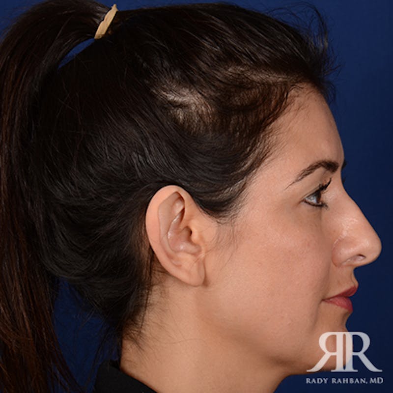 Ear Pinning Surgery Before & After Gallery - Patient 233319 - Image 5