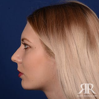 Chin Augmentation Before & After Gallery - Patient 118071 - Image 6