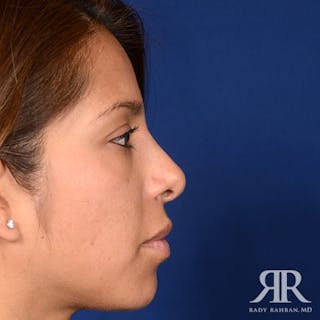 Corrective / Revision Rhinoplasty Before & After Gallery - Patient 225597 - Image 4