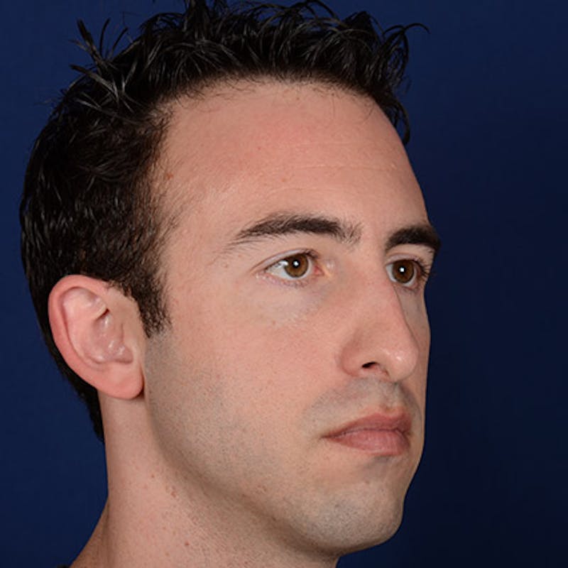 Rhinoplasty w/ Chin Implant Before & After Gallery - Patient 166162 - Image 3