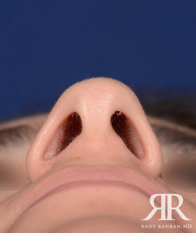 Rhinoplasty Close Up Before & After Gallery - Patient 262638 - Image 5