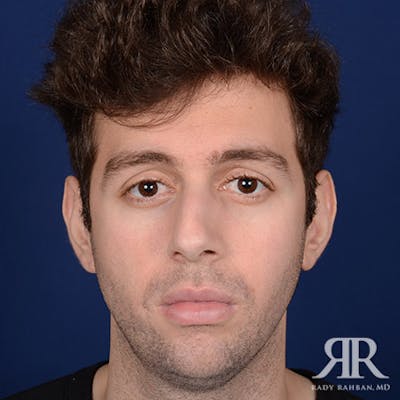 Male Rhinoplasty Before & After Gallery - Patient 396225 - Image 1