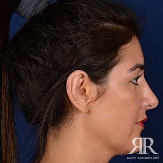 Ear Pinning Surgery Before & After Gallery - Patient 233319 - Image 6