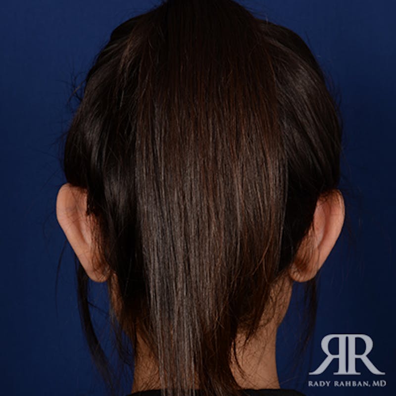 Ear Pinning Surgery Before & After Gallery - Patient 233319 - Image 7