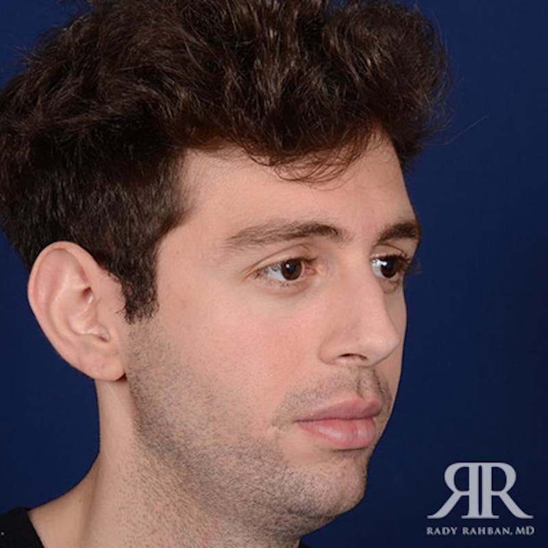 Male Rhinoplasty Before & After Gallery - Patient 396225 - Image 3
