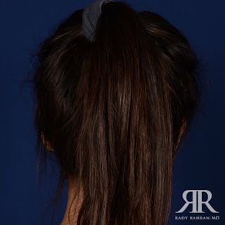 Ear Pinning Surgery Before & After Gallery - Patient 233319 - Image 8