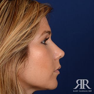 Female Rhinoplasty Before & After Gallery - Patient 225866 - Image 6