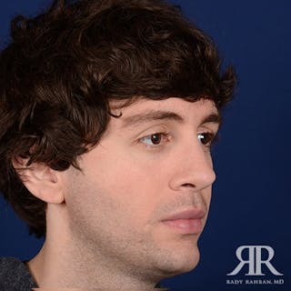 Male Rhinoplasty Before & After Gallery - Patient 396225 - Image 4