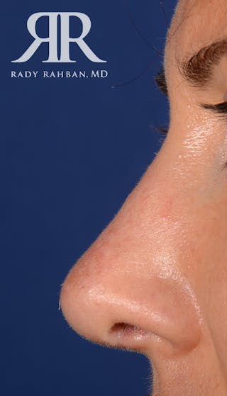 Rhinoplasty Close Up Before & After Gallery - Patient 398162 - Image 2