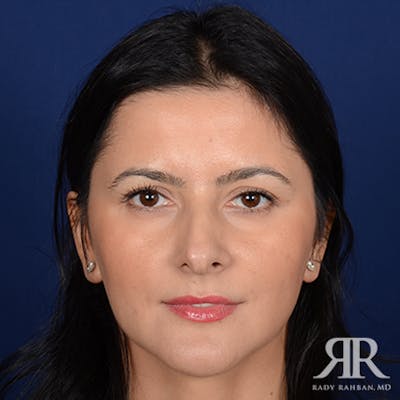 Corrective / Revision Rhinoplasty Before & After Gallery - Patient 399035 - Image 1