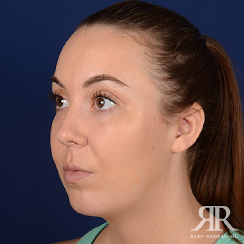 Chin Augmentation Before & After Gallery - Patient 262402 - Image 4