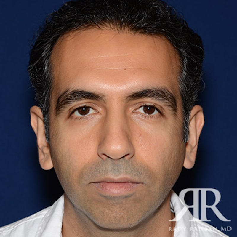 Ear Pinning Surgery Before & After Gallery - Patient 204329 - Image 1