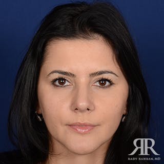 Corrective / Revision Rhinoplasty Before & After Gallery - Patient 399035 - Image 2