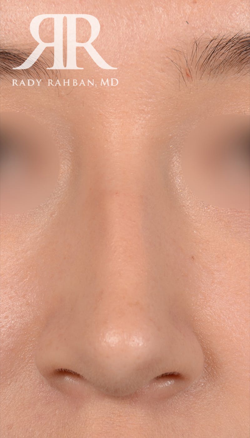 Rhinoplasty Close Up Before & After Gallery - Patient 398162 - Image 3