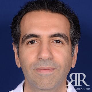 Ear Pinning Surgery Before & After Gallery - Patient 204329 - Image 2