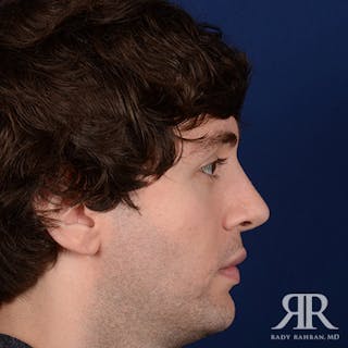 Male Rhinoplasty Before & After Gallery - Patient 396225 - Image 6