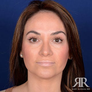 Rhinoplasty w/ Chin Implant Before & After Gallery - Patient 270906 - Image 2