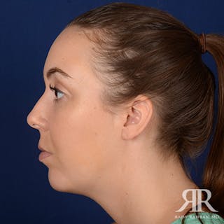 Chin Augmentation Before & After Gallery - Patient 262402 - Image 6