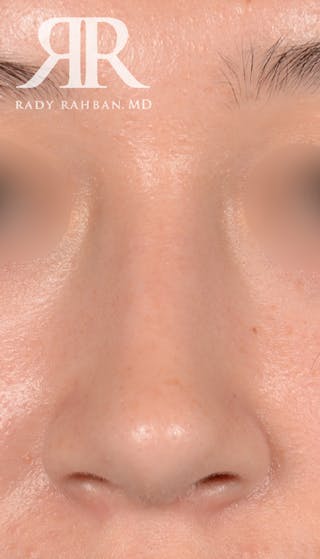 Rhinoplasty Close Up Before & After Gallery - Patient 398162 - Image 4
