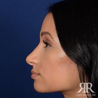 Ethnic Rhinoplasty Before & After Gallery - Patient 626245 - Image 6