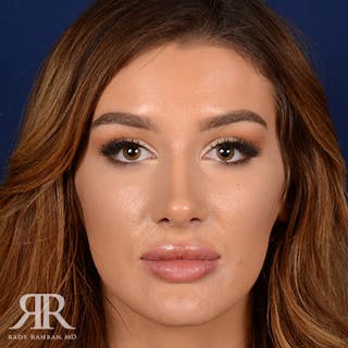 Female Rhinoplasty Before & After Gallery - Patient 258924 - Image 2