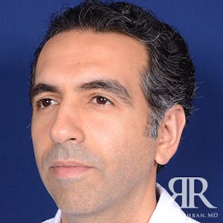 Ear Pinning Surgery Before & After Gallery - Patient 204329 - Image 4