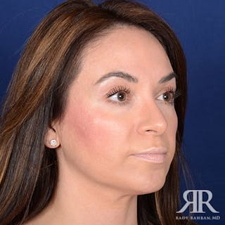 Rhinoplasty w/ Chin Implant Before & After Gallery - Patient 270906 - Image 4