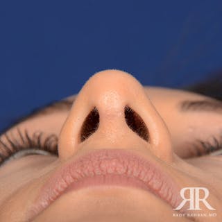 Ethnic Rhinoplasty Before & After Gallery - Patient 626245 - Image 8