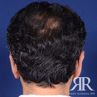 Ear Pinning Surgery Before & After Gallery - Patient 204329 - Image 6