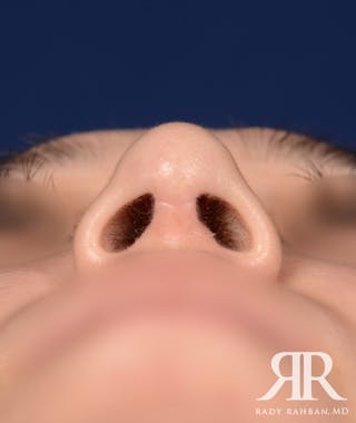 Rhinoplasty Close Up Before & After Gallery - Patient 398162 - Image 6