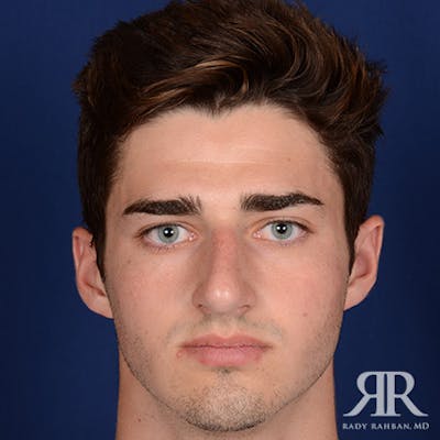 Male Rhinoplasty Before & After Gallery - Patient 241960 - Image 1