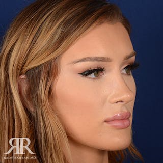 Female Rhinoplasty Before & After Gallery - Patient 258924 - Image 4