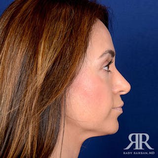 Rhinoplasty w/ Chin Implant Before & After Gallery - Patient 270906 - Image 6