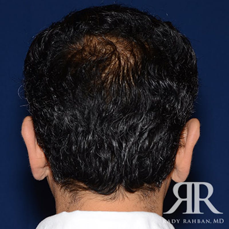 Ear Pinning Surgery Before & After Gallery - Patient 204329 - Image 5