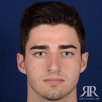 Male Rhinoplasty Before & After Gallery - Patient 241960 - Image 2