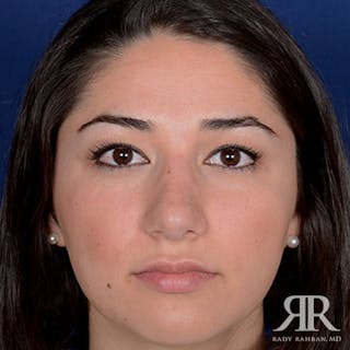 Ethnic Rhinoplasty Before & After Gallery - Patient 215578 - Image 2