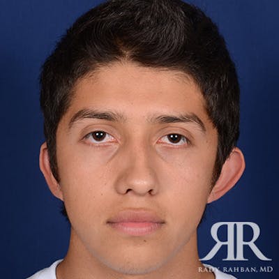 Ear Pinning Surgery Before & After Gallery - Patient 269906 - Image 1