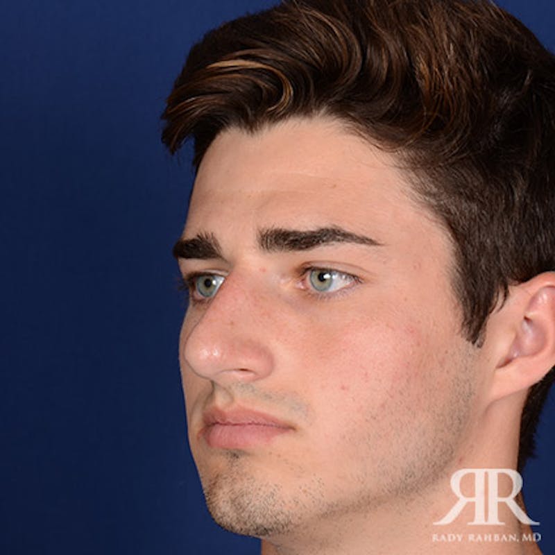Male Rhinoplasty Before & After Gallery - Patient 241960 - Image 3