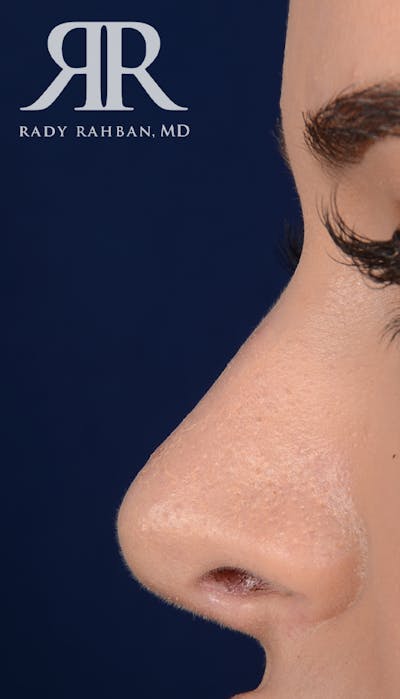 Rhinoplasty Close Up Before & After Gallery - Patient 141221 - Image 2