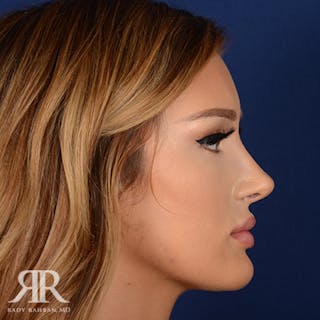 Female Rhinoplasty Before & After Gallery - Patient 258924 - Image 6
