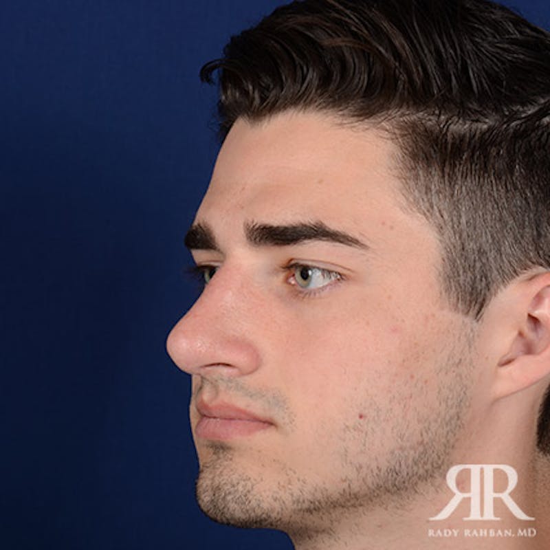 Male Rhinoplasty Before & After Gallery - Patient 241960 - Image 4