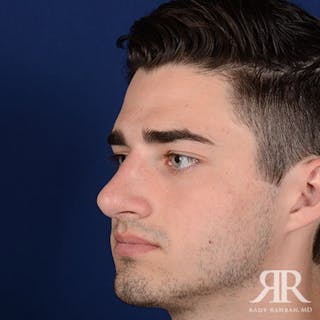 Male Rhinoplasty Before & After Gallery - Patient 241960 - Image 4