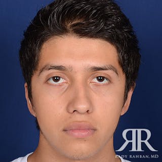 Ear Pinning Surgery Before & After Gallery - Patient 269906 - Image 2