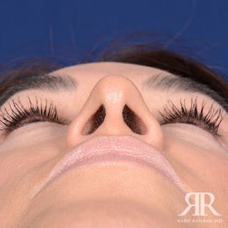 Rhinoplasty w/ Chin Implant Before & After Gallery - Patient 270906 - Image 8