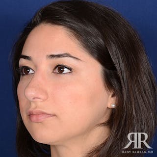 Ethnic Rhinoplasty Before & After Gallery - Patient 215578 - Image 4