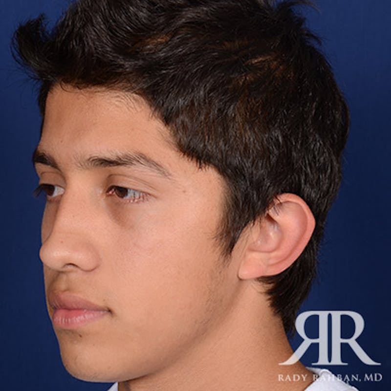 Ear Pinning Surgery Before & After Gallery - Patient 269906 - Image 3
