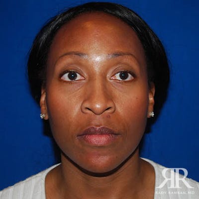 Rhinoplasty w/ Chin Implant Before & After Gallery - Patient 330943 - Image 1