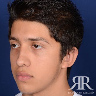 Ear Pinning Surgery Before & After Gallery - Patient 269906 - Image 4